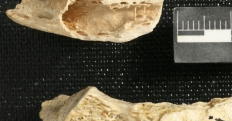 A fost descoperită cea mai veche tumoare
