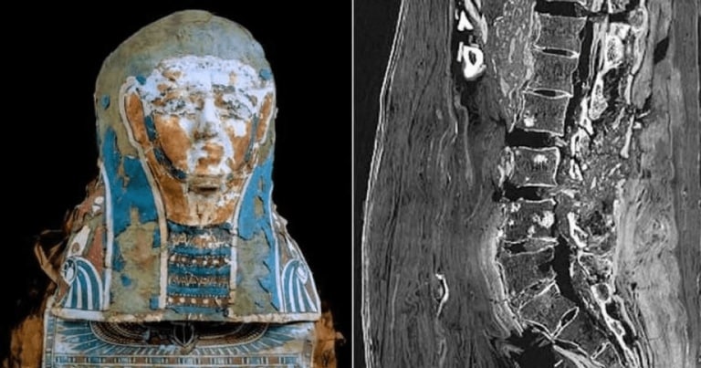 Cel mai vechi caz de cancer la prostatã din Egipt