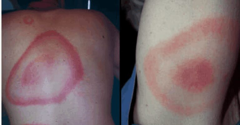 Căpușele, Lyme și misterul bolii Lyme: ce spun documentele declasificate