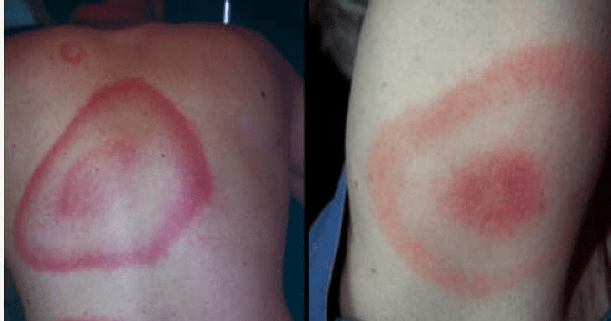 Căpușele, Lyme și misterul bolii Lyme: ce spun documentele declasificate